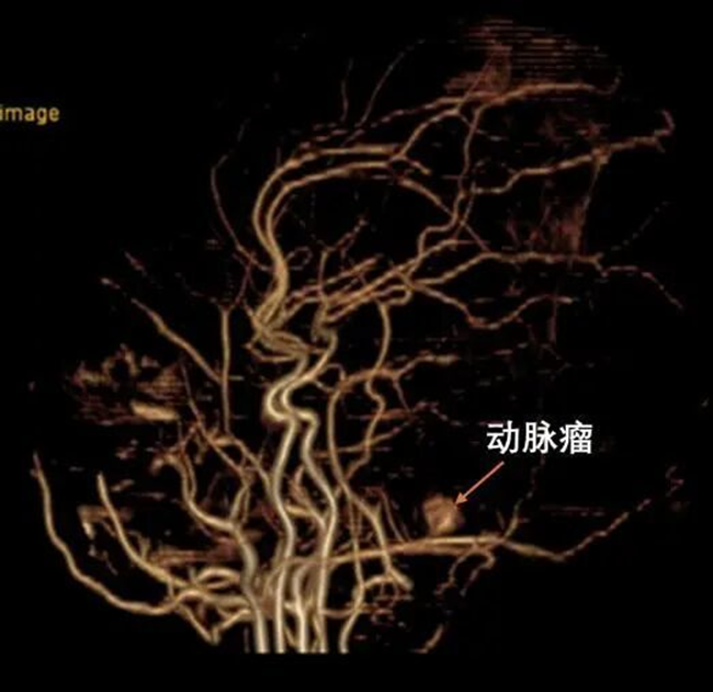 俩新生儿颅内得动脉瘤，患儿在山大附属儿童医院重获健康